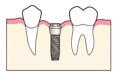 インプラント一次手術