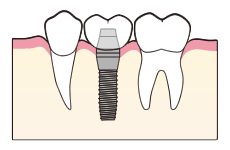 インプラント二次手術