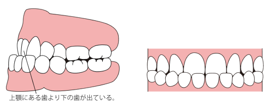 下顎前突（かがくぜんとつ）