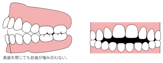 開咬（かいこう）