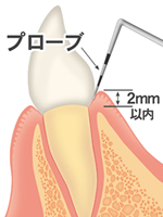 プロービング検査